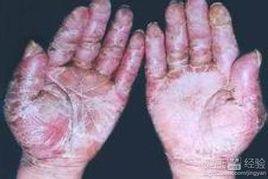 糟皮病 糟皮病