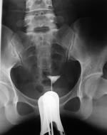 子宮輸卵管碘油造影 子宮輸卵管碘油造影