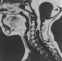 小腦發育不良 小腦發育不良