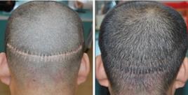 疤痕體種植 疤痕體種植