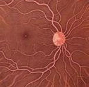 高鈉血症 高鈉血症