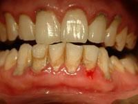 慢性牙周炎 慢性牙周炎