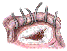 三尖瓣關閉不全