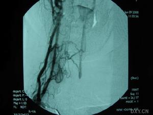 鎖骨下動脈盜血綜合徵