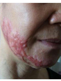 深二度燒傷 深二度燒傷