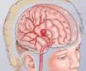 《急性腦血管疾病的診斷和治療》