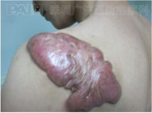 疤痕治療網 疤痕治療網