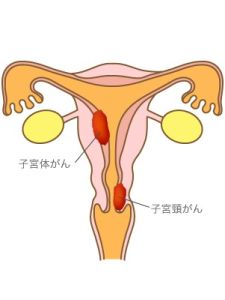 子宮體 子宮體