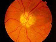 視乳頭玻璃疣 視乳頭玻璃疣