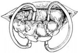 結腸損傷部外置造瘺術 結腸損傷部外置造瘺術