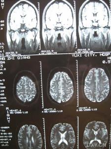 自我意識障礙 自我意識障礙