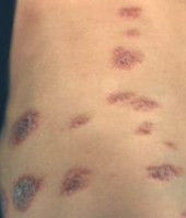 過敏性濕疹 過敏性濕疹