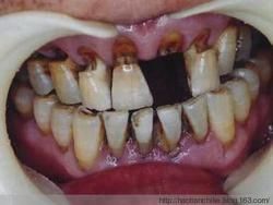 牙列缺損 牙列缺損