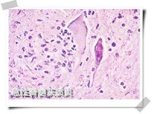 亞急性壞死性脊髓炎綜合徵