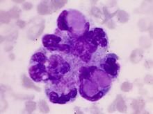 狼瘡細胞 狼瘡細胞