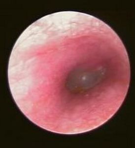 壞死性外耳道炎 壞死性外耳道炎