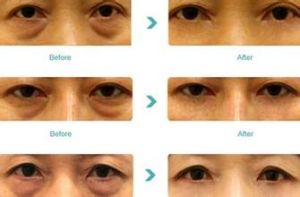 眼袋抽脂手術效果