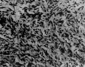 卵巢無性細胞瘤