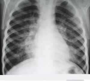 大葉性肺炎 大葉性肺炎