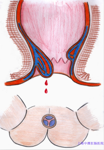 痔瘡出血示例圖