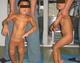 肌張力障礙 肌張力障礙