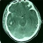 顱內壓增高綜合症