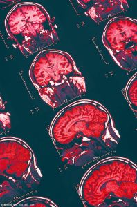 兒童失神性癲癇 兒童失神性癲癇