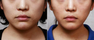 下頜角瘦臉 下頜角瘦臉