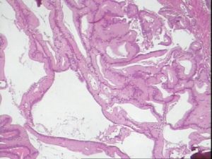 粘液性腫瘤 粘液性腫瘤