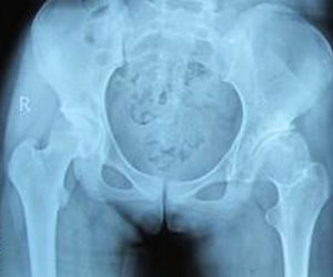 發育性髖關節發育不良 發育性髖關節發育不良