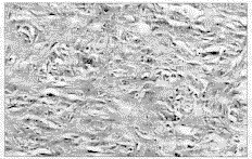 眶內纖維組織細胞瘤