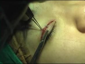 雙眼皮手術
