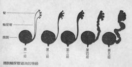 膀胱輸尿管回流