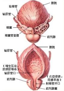 慢性前列腺炎