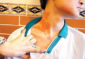 頸部勒傷 頸部勒傷