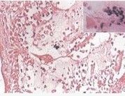 食管腺癌 食管腺癌