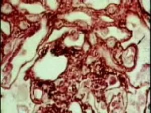 兒童紫癜性腎炎