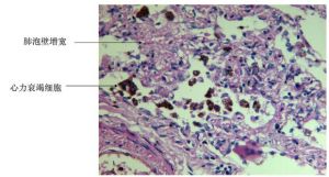 肺泡腔內有心力衰竭細胞