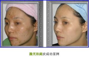 雷射祛斑成功案例