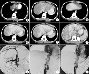 布加氏綜合徵 布加氏綜合徵