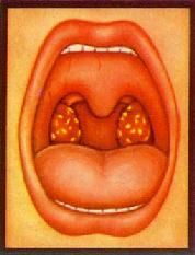 腺樣體肥大 腺樣體肥大