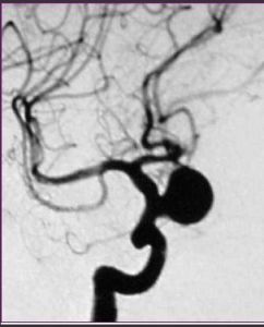 顱內動脈瘤 顱內動脈瘤
