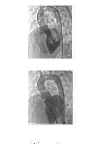 完全性房室傳導阻滯