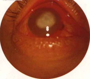 單純皰疹性角膜炎