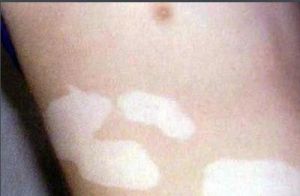 皮膚白班 皮膚白班