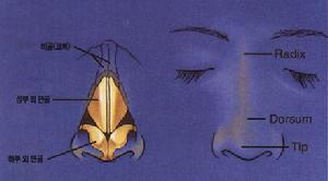 複雜鼻尖整形術