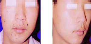 雷射點痣的前後對比