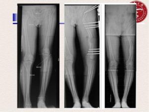 關節強直 關節強直