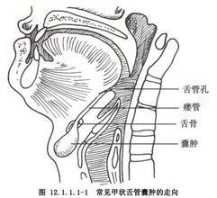 甲狀腺舌管囊腫切除術 甲狀腺舌管囊腫切除術