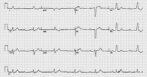 高度房室傳導阻滯